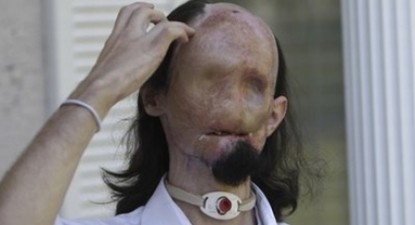 Imagini șocante: Primul transplant total de față din SUA - 000053b1e684c9e7ea73727b2238ce18.jpg