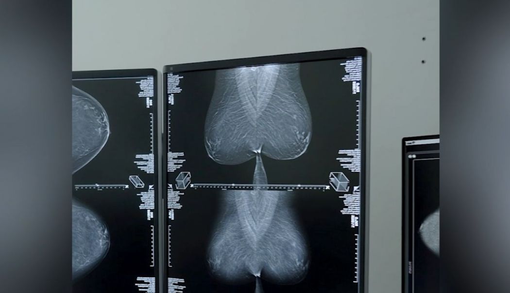 Mamografii gratuite pentru depistarea cancerului la sân, la Năvodari - 1-1752587426.jpg