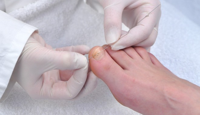 Atenție la unghiile încarnate - 10iuliemediculunghii-1373460158.jpg