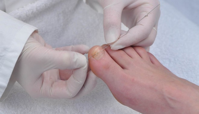 Unghiile încarnate duc la complicații - 12augmediculunghiiincarnate-1344775146.jpg