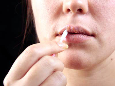 Herpesul, semn de boală - 18novmediculherpes-1353247882.jpg