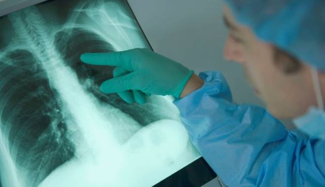 Analize GRATUITE pentru depistarea cancerului pulmonar - 29ianuarieinvestigatiicancerpulm-1422539091.jpg