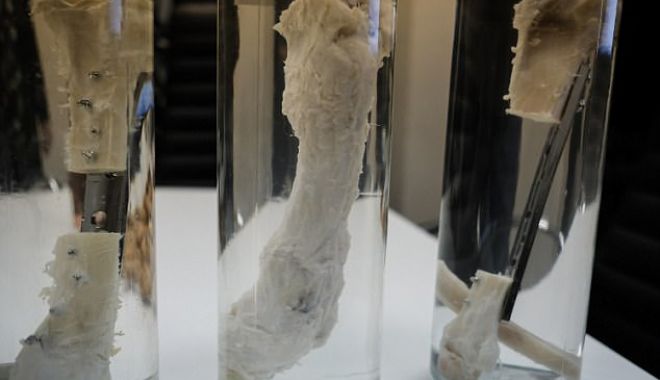 Fragment de os dezvoltat în laborator, implantat cu succes în tibia fracturată a unui bărbat - 48fda511000005780imagea115181128-1520504170.jpg
