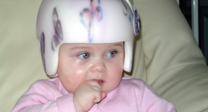 Torticollisul congenital (gâtul strâmb) poate fi corectat chirurgical - 67a381bd43fbf14a0a122b8ae1bb271a.jpg