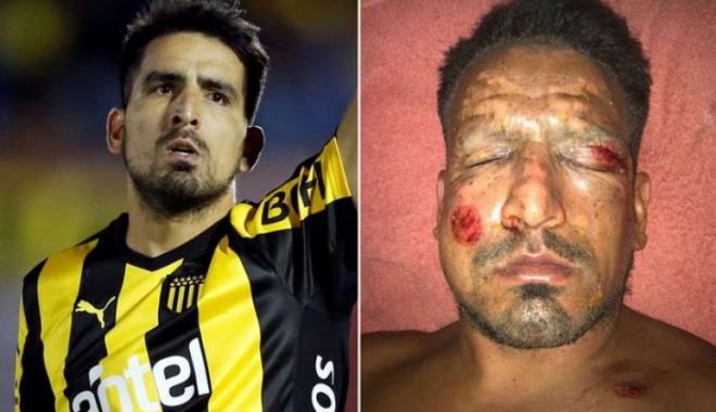 Un fotbalist de top a suferit arsuri grave la față de la artificii - accidentlucasviatri37260800-1514968096.jpg