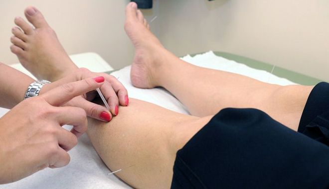 Acupunctura este eficientă și în cazul gonartrozei - acupunctura-1657212189.jpg