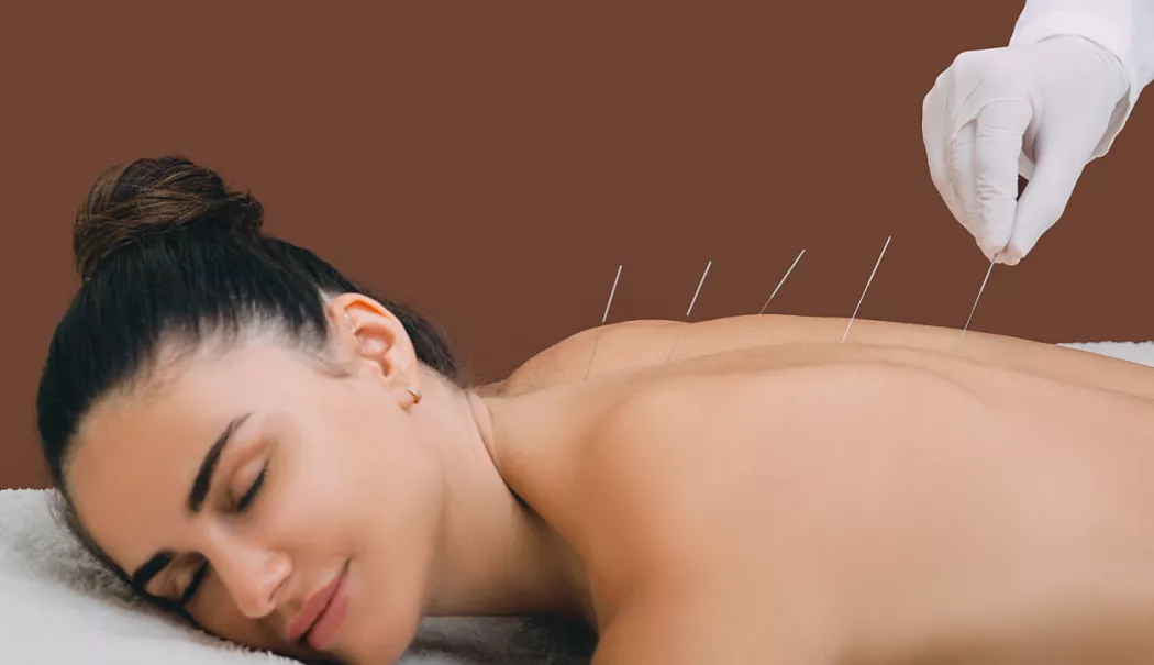 Acupunctura, soluția naturală pentru durere și stres - acupunctura-1772965721.webp