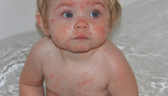 Epidemie de rujeolă / Alte 23 de cazuri noi, în ultima săptămână - articole508-1475845446.jpg