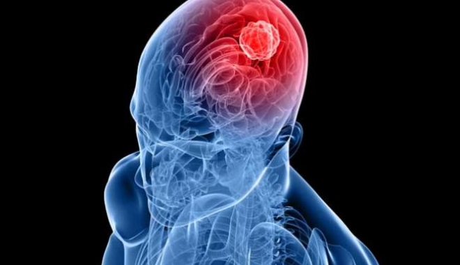 Aspirina lichidă ar putea ucide tumorile cerebrale - aspirinalichida-1467198875.jpg