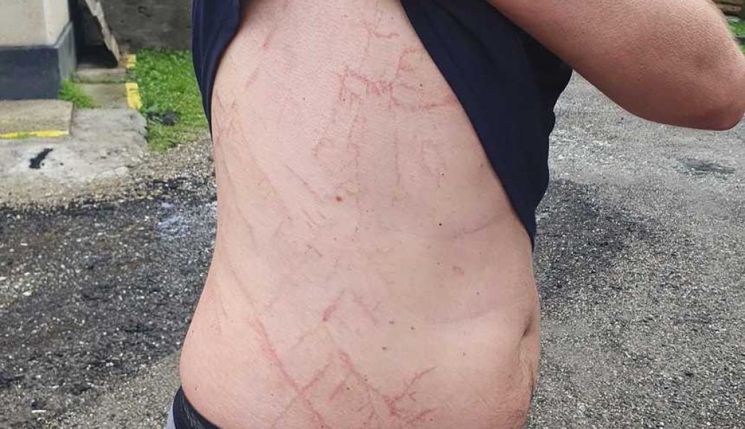 Bărbatul surprins de fulger pe munte arată ce a pățit. Salvamontiștii fac recomandări - barbattrasnit-1724258004.jpg