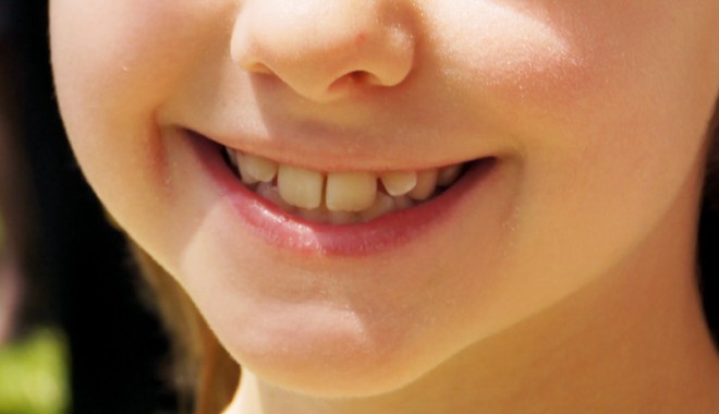 Scrâșnitul dinților vă poate afecta grav dantura! - bruxism-1359729840.jpg