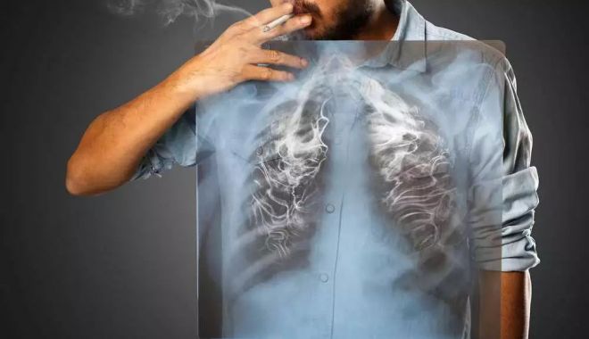 Beatrice Mahler: 694 de cazuri de cancer pulmonar diagnosticate în primele şase luni ale anului - peste 61% cu metastaze