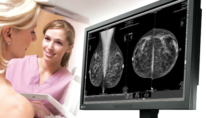 6.000 de românce, diagnosticate cu cancer mamar în 2011 - cancermamar-1332080657.jpg