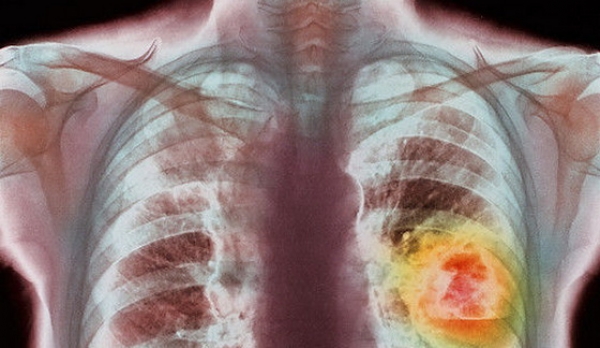 Primăria Cumpăna demarează o campanie de depistare a cancerului pulmonar și accidentelor vasculare ischiemice - cancerpulmonar-1361369682.jpg