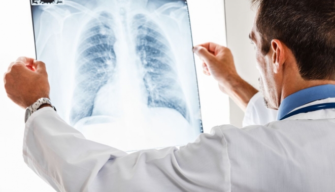 Fumătorii, predispuși la cancer pulmonar - cancerpulmonar-1503569553.jpg