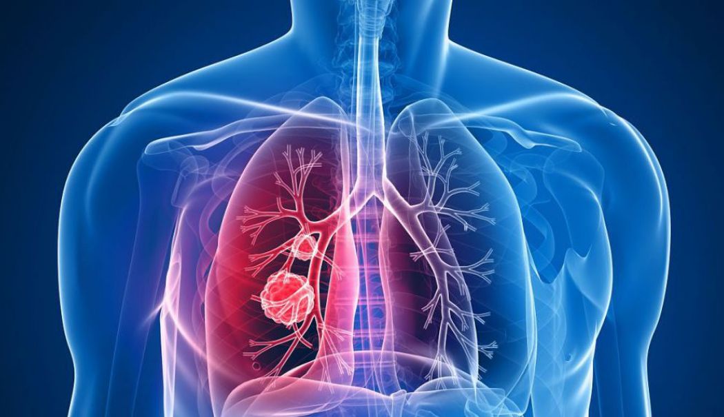 Creşterea cazurilor de cancer pulmonar la nefumători, legată de un gaz radioactiv din aer - cancerpulmonar-1713109664.jpg