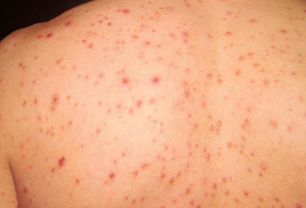 Un politician antivaccin s-a îmbolnăvit de varicelă - capdvaricellachickenpox-1553120043.jpg