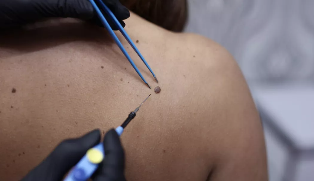 Cauterizarea negilor - soluția rapidă pentru eliminarea verucilor rezistente - cauterizare-1771243216.webp
