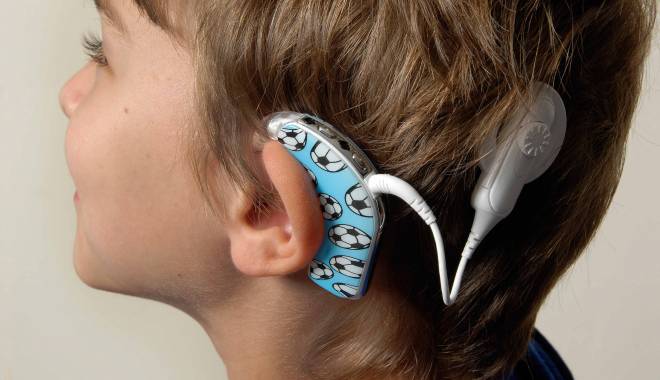 Bine de știut! De câte implanturi pot beneficia pacienții cu surditate - cochlearimplant-1442998799.jpg