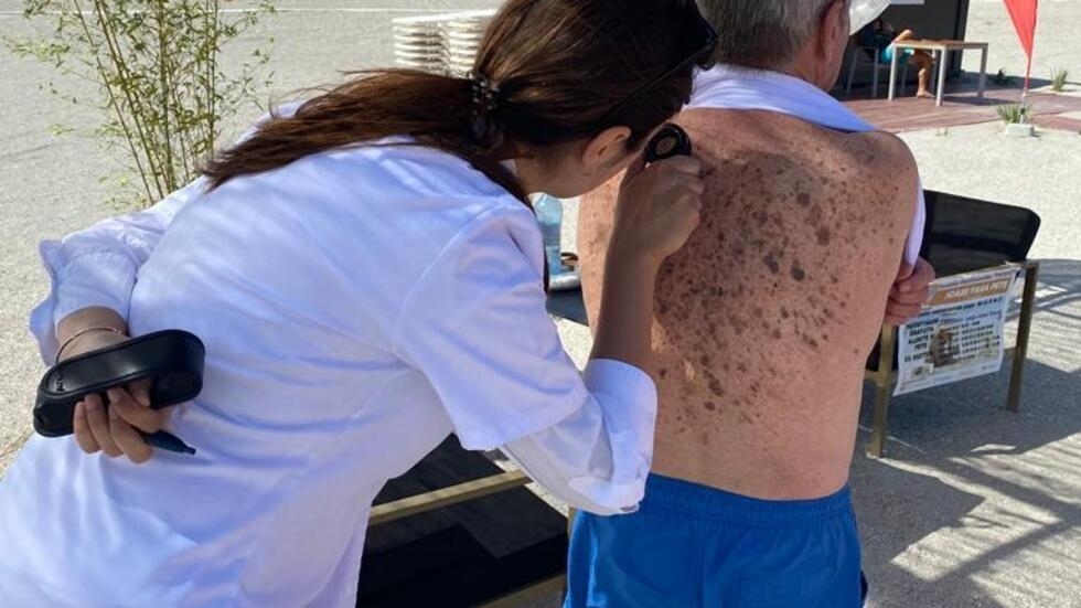 Consultații dermatologice gratuite la mare pentru depistarea cancerului de piele