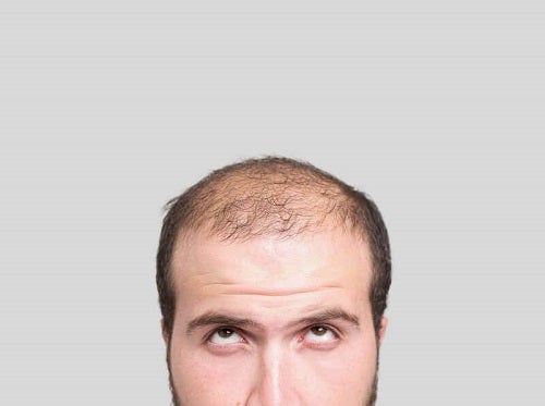 Adio, chelie! A fost aprobat primul medicament împotriva alopeciei - cumsascapidechelie-1655204861.jpg