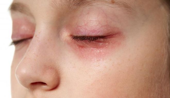 Au ajuns la spital cu arsuri la ochi! Cauza a fost una neașteptată… - ddd-1580893458.jpg