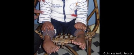 Un băiețel indian, în vârstă de un an, are 34 de degete! - degete-1311664611.jpg