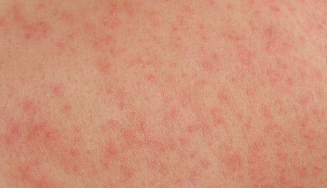 Care sunt principalele simptome ale dermatitei atopice - dermatita-1525766330.jpg