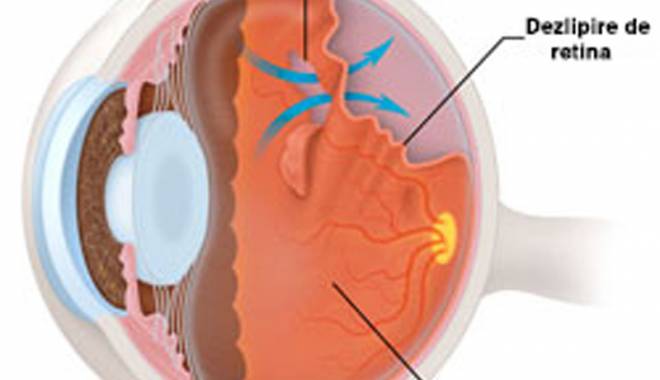 Dezlipirea de retină: când ajunge pacientul la 