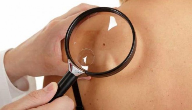 Liceeni constănțeni, testați pentru cancerul de piele - feritivademelanomcelmaiagresivca-1370348933.jpg