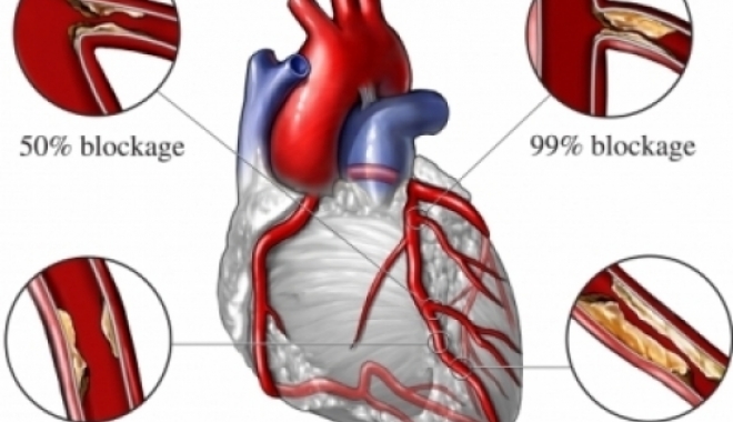 Finanțare europeană pentru cercetare privind bolile cardio-vasculare - finantarecercetareboli-1501671417.jpg