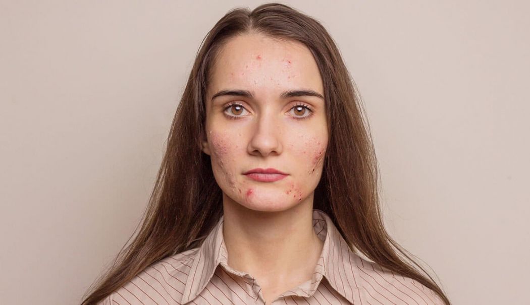 Acneea la adolescenți: de ce tratamentele găsite pe rețelele sociale pot fi periculoase - fond-acneea-1756224652.jpg