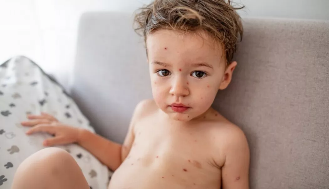 Bubele dulci la copii. Cum recunoașteți impetigo și cum îl opriți din răspândire - fond-bube-1770209311.webp