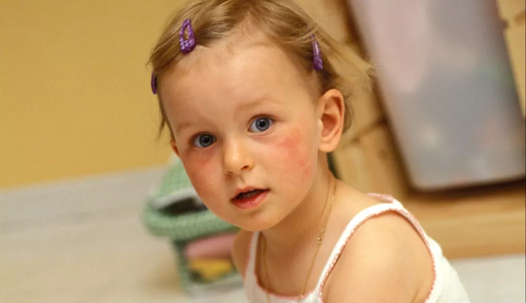 Dermatita atopică la copii. Greșelile care agravează boala fără să îți dai seama - fond-dermatita-2-1776071686.webp