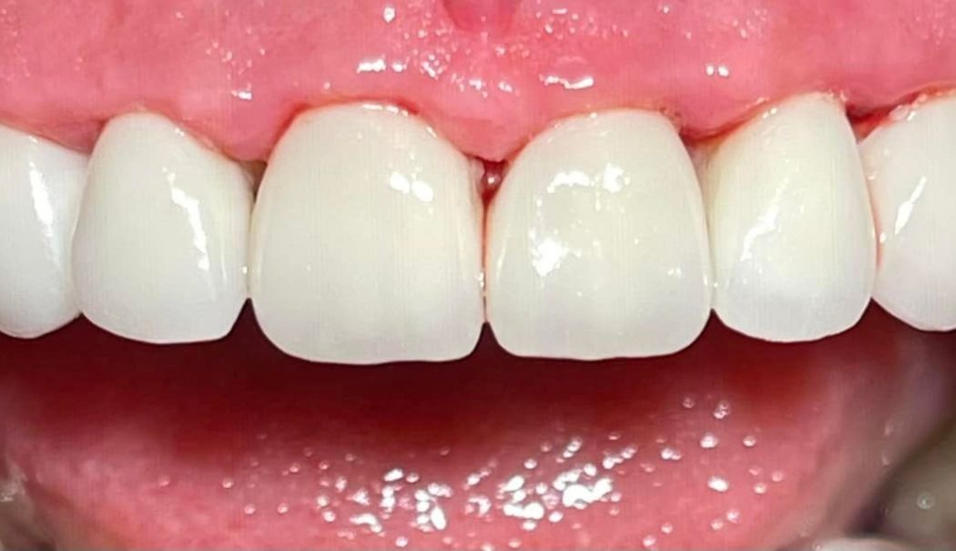 Fațetele dentare, o soluție în estetica modernă, la M&M Dental Team - fond-fatete-dentare-1713446854.jpg