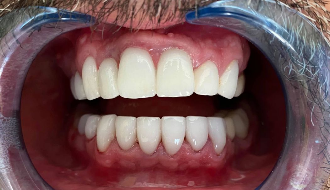 Fațetele dentare, o soluție în estetica modernă, la M&M Dental Team - fond-fatete-dentarejpg-2-1713446866.jpg