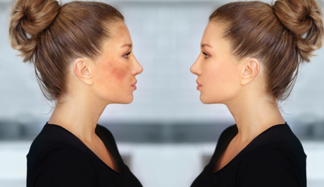 Melasma - secretul pentru un ten uniform și fără pete - fond-melasmajpg-2-1754307890.jpg
