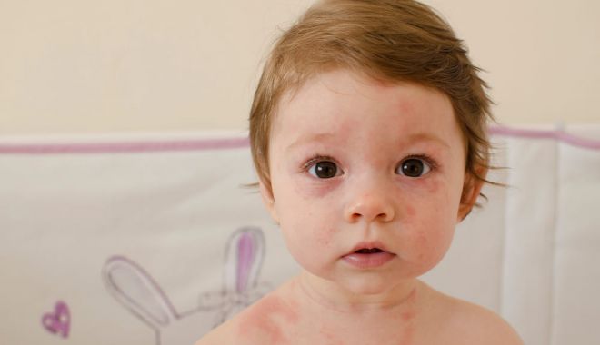 Roseola infantum este o boală infecţioasă, asemănătoare rujeolei - fond-roseola-1-1707916804.jpg