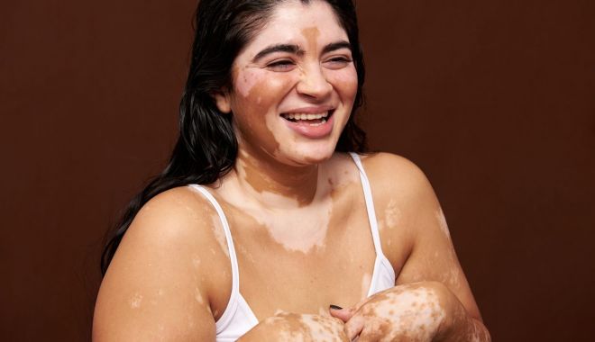 Nu vă speriaţi! Vitiligo nu este o boală contagioasă - fondvitiligo2-1672665129.jpg