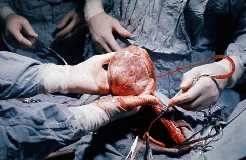 Programul de transplant cardiac, reluat anul acesta - hearttransplantation-1368699244.jpg