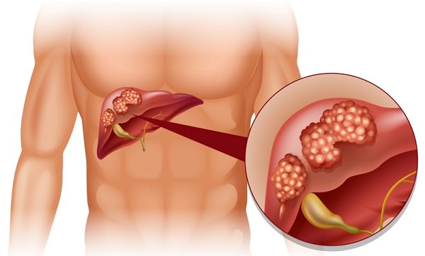 Testări gratuite pentru bolnavii cu afecțiuni hepatice - hepatitacsiozonoterapia-1526540183.jpg