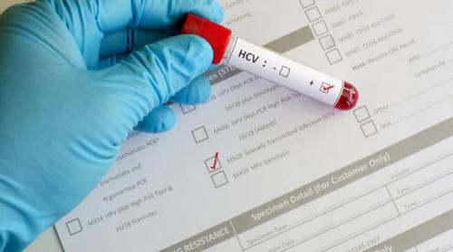 Tratamentul fără interferon, disponibil pentru 12.000 de pacienți - hepatitactratamentfarainterferon-1493989602.jpg