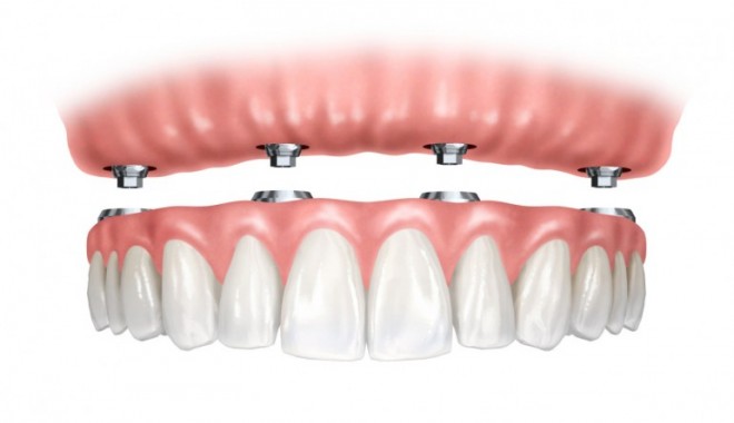 Implant dentar care reproduce mobilitatea naturala a dintelui, inventat de doi medici români - implantdentar1770x521-1406205618.jpg