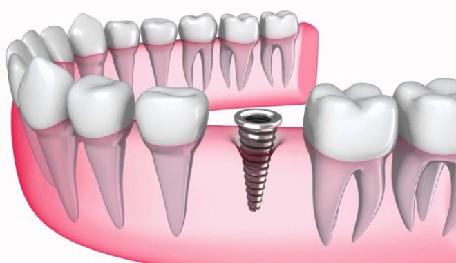 Pași esențiali pentru un implant dentar de succes - implantdentarieftin-1516865642.jpg