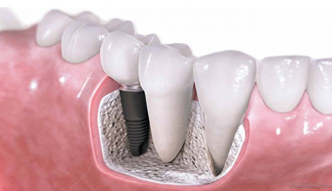 Părerile pacienților despre diverse tipuri de implant dentar: preț, durată, aspect - implantdentarpret-1630568057.jpg