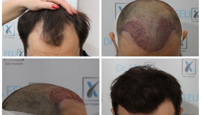 Dr. Felix Hair Implant - implant de păr și ajutor din partea specialiștilor în domeniu - implantpardrfelixhairimplant-1657274207.jpeg