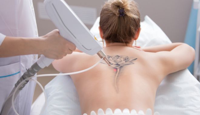 Tatuajele pot fi îndepărtate prin mai multe metode - indepartarea-tatuajelor-1682102622.jpg
