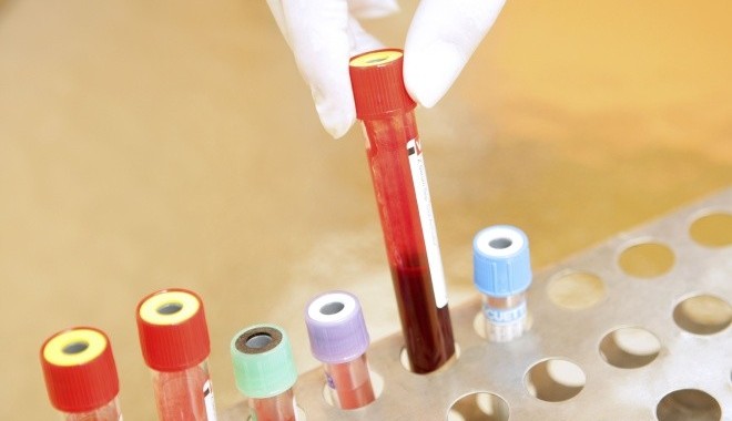 Cum arată sângele tău - infectiehivnorthf88f6285748-1396017572.jpg