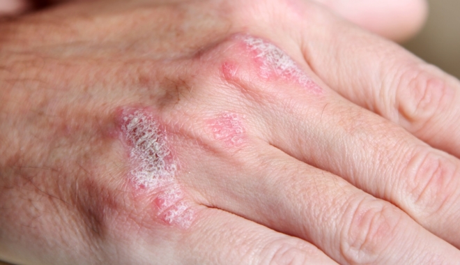 Cum pot fi tratate leziunile cutanate? - inflamatii-1508765052.jpg