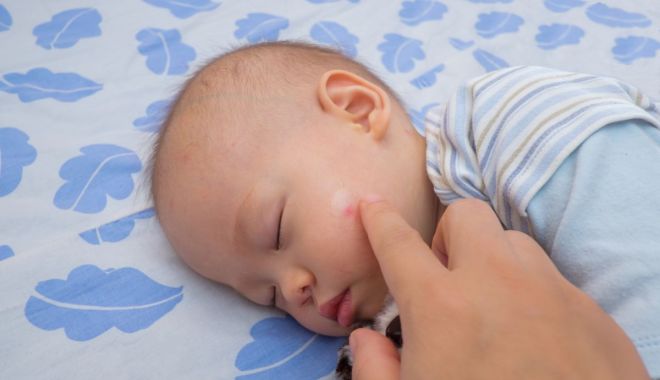 Ați fost înțepați de albine? Care este primul lucru pe care trebuie să îl faceți - intepaturialbine1-1650986160.jpg
